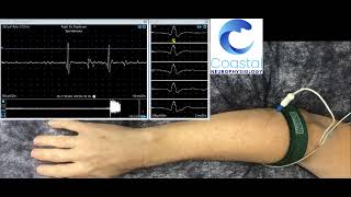 Needle EMG demonstration [upl. by Pontias697]