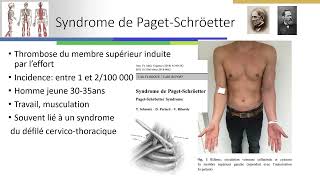 Thrombose veineuse profonde du membre supérieur [upl. by Rattan]