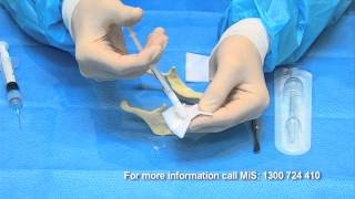 Bone Grafting simplified with BondBone by MIS [upl. by Anabal]