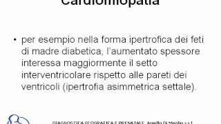 Cardiomiopatia [upl. by Kiehl]