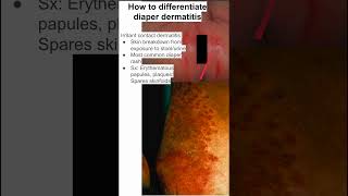 How to differentiate diaper dermatitis [upl. by Kaylyn]