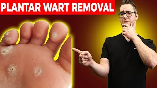 1 BEST Plantar Wart Removal How To Get Rid of Warts Treatments [upl. by Swisher]