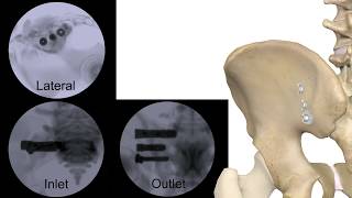 Corelink Entasis Sacroiliac Joint Fusion [upl. by Rondon]