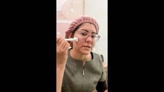 Microneedle Away Acne Scars At Home [upl. by Mllly119]