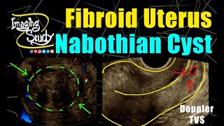 Fibroid Uterus with Nabothian Cyst  TVS  Doppler  Ultrasound  Case 249 [upl. by Acemahs684]