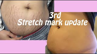 my 3rd stretch mark treatment update E2 sublative laser [upl. by Attenad983]