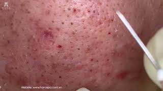 Big Cystic Acne Blackheads Extraction Blackheads amp Milia Whiteheads Removal Pimple Popping [upl. by Atina]