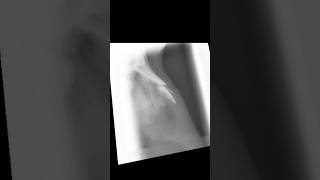 Minimally displaced nasal bone fracture xray [upl. by Treborsemaj]