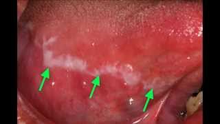 Líquen Plano Bucal [upl. by Mongeau]