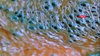 Solar Comedones and Blackheads  Blackhead King [upl. by Drofiar]