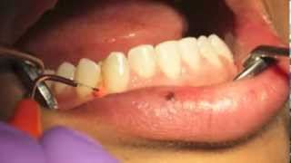 Cosmetic Laser DentistryImplant Dental Gum Surgery ClinicManilaPhilippinesDental Tourism [upl. by Fineberg218]