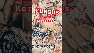 FUNGUS  SEBHORRIC KERATOSIS Mincecore Lovers VORACIOUS PRURITUS IN NECROTIC HARMONY EP [upl. by Nitsew405]