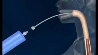 Intragastric Balloon [upl. by Yrrehc]