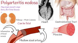 Polyarteritis nodosa  symptoms and treatment [upl. by Araiet197]