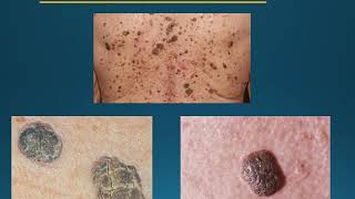 Skin cancer education [upl. by Nhtanhoj153]