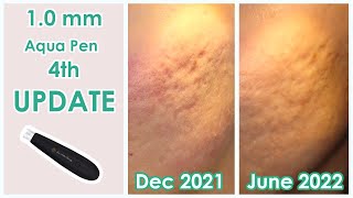 10mm Microneedling 4th Update [upl. by Vedis]