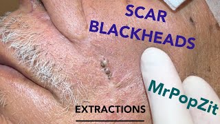 Giant blackheads imbedded in scar tissue extracted Common occurrence with surgical procedures [upl. by Lawford373]