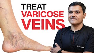 VASCULAR SURGEON Shares 11 Proven Ways to TREAT VARICOSE VEINS [upl. by Mchugh790]