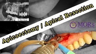 APICOECTOMY  Apical Resection  Root Canal Surgery [upl. by Sumaes]