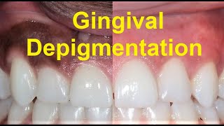 All about Gingival Pigmentation and Depigmentation [upl. by Aimekahs]