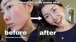 NO FOUNDATION your skin but BETTER makeup routine for acne prone skin [upl. by Crystie]