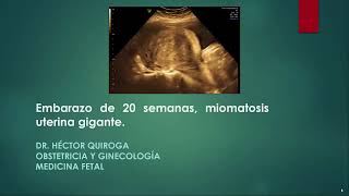 Embarazo de 20 semanas y miomatosis uterina gigante [upl. by Carson921]