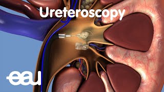 Removal of kidney stones URS [upl. by Pavier]