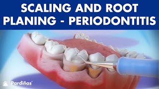 Treatment of periodontal disease  Scaling and root planing  Tartar © [upl. by Noram]