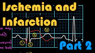 Ischemia Infarction and the Waveforms Q through U Part 2 How to Read an EKG Curriculum [upl. by Eniledgam813]