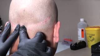 Micro Hair Pigmentation MHP van FUT litteken bij Beauty Care Nederland BCN te Katwijk [upl. by Llevart]