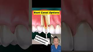 Top 4 Root Canal Alternatives You Should Know dentallan dentist shorts [upl. by Cini]