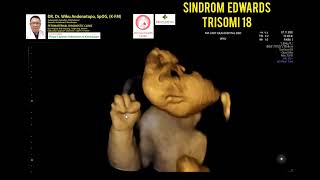 Trisomi 18 Sindrome Edwards [upl. by Sera]