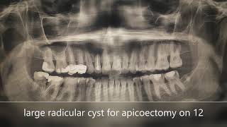 Apicoectomy of fluctuant radicular cyst of 12 [upl. by Ivets]