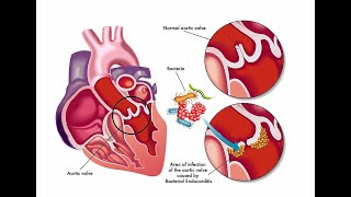 Treatment For Infective Endocarditis [upl. by Renaxela]