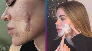 Khloé Kardashian Reveals Just How Scary Her Skin Cancer Situation Was [upl. by Coppock651]