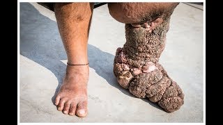 Filariasis or elephantiasis causes symptoms and treatment [upl. by Sivatnod677]