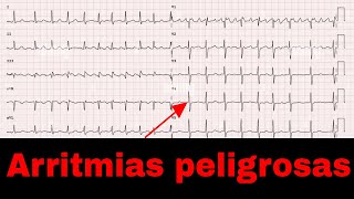 Bloqueos y arritmias cardiacas bloqueos malignos Con Canal Medizi [upl. by Coben]