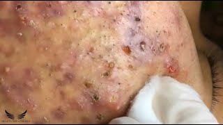 Blackhead Whitehead Removal  Cystic Acne Treatment  Elderly Pimple Popping  Facial Acne Spa 082 [upl. by Ebert]