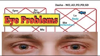 Agni Tatva  Eye sight Problems in Astrology [upl. by Donahue]