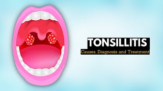 Tonsillitis Causes Signs and Symptoms Diagnosis and Treatment [upl. by Kabob856]