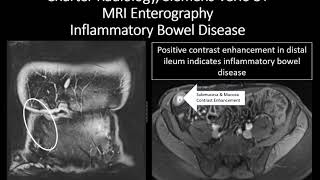 MRI Enterography Inflammatory Bowel Disease [upl. by Urban501]