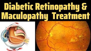 Diabetic Retinopathy Optos  Drss Eye  Diabetic Retinopathy Treatment  Maculopathy Treatment [upl. by Marshall]