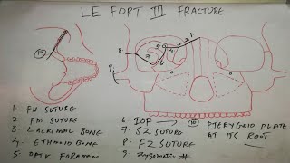 Le fort III fracture line [upl. by Carlye344]