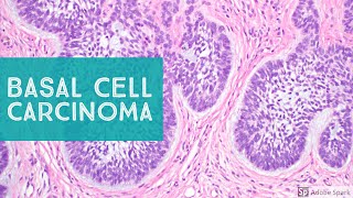 Basal Cell Carcinoma BCC 101  Dermpath Basics Explained by a Dermatopathologist [upl. by Drofnats761]