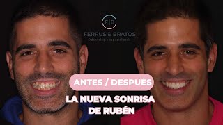 🦷CARILLAS DENTALES Antes y después ✨ CASO REAL [upl. by Yot]