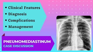 Case Presentation  Acute Chest Pain  Pneumomediastinum [upl. by Tansy]