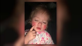 Minn todler born with rare allergy to water [upl. by Godber]