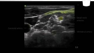 Cervical Plexus Block  Nerve Localization [upl. by Irv]