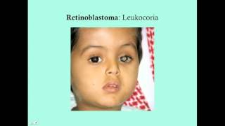 Retinoblastoma  CRASH Medical Review Series [upl. by Toney507]