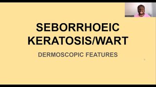 DERMOSCOPIC FEATURES OF SEBORRHOIEC KERATOSISWART [upl. by Elades]